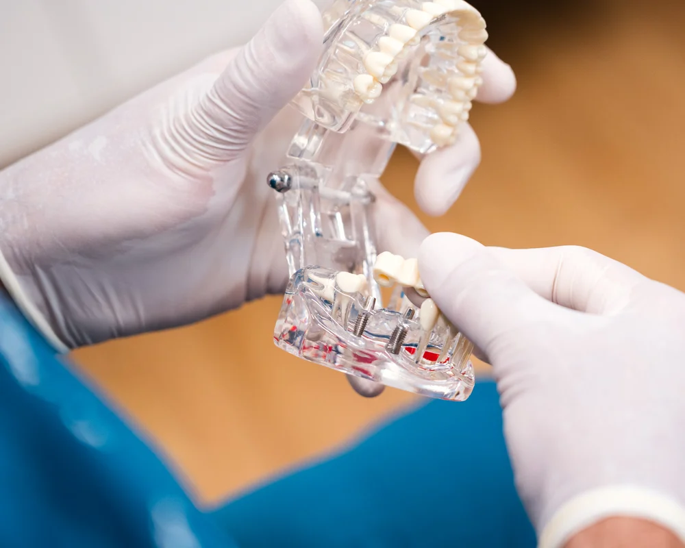 Immagine di una dentiera con impianti dentali